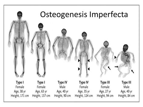 osteogenesis imperfecta - maura tierney